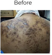 Keloid scar removal in Ayurveda